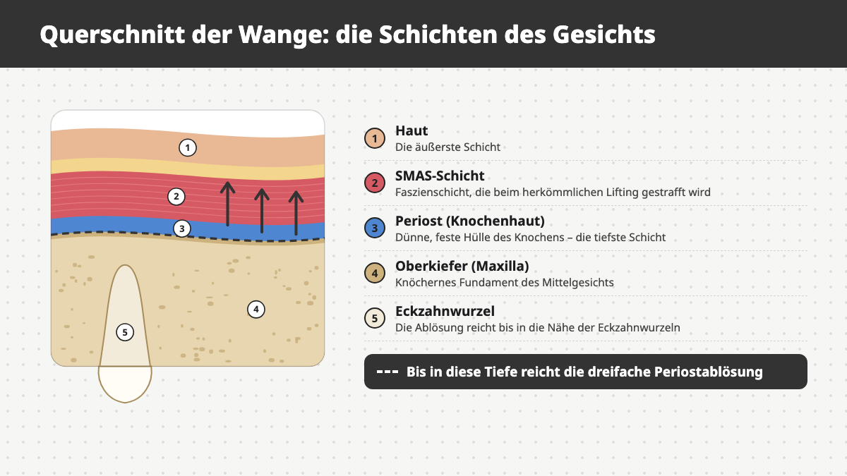 Querschnitt der Wange mit Haut, SMAS-Schicht, Periost, Oberkiefer (Maxilla) und Eckzahnwurzel