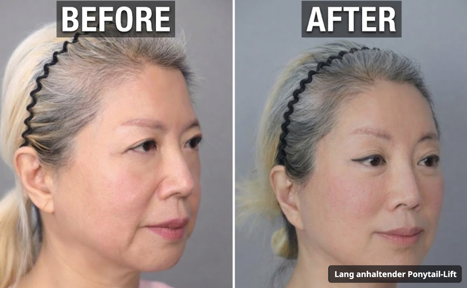 Vorher und nachher: Ponytail-Lift mit dreifacher Periostablösung
